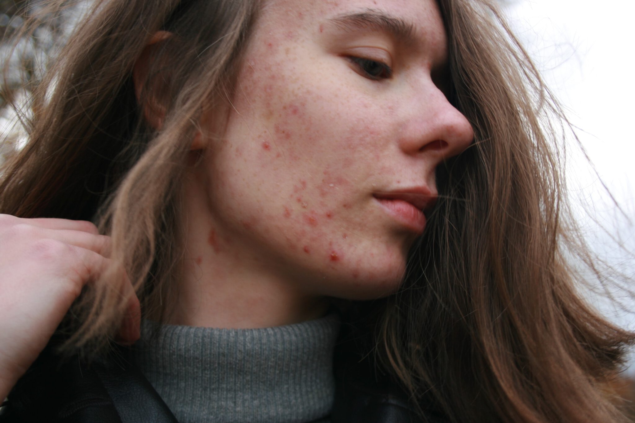 helpen bij acne